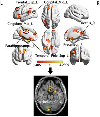 Relationship between temporal dynamics of intrinsic brain activity and motor function remodeling in patients with acute BGIS